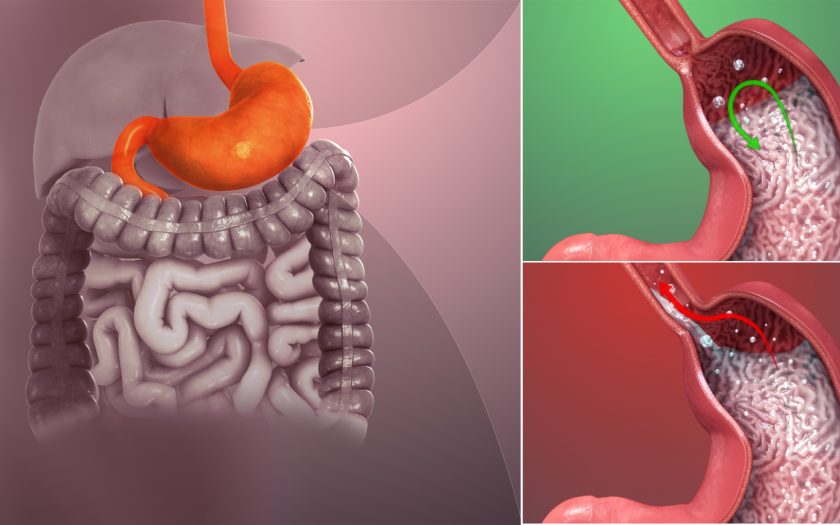 Gastroesophageal